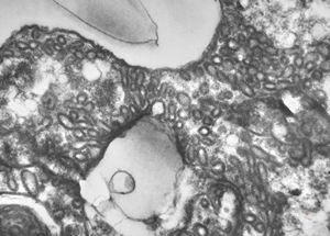 M,50y. | Pneumocystis carinii - lung M,50y. | Pneumocystis carinii - lung
